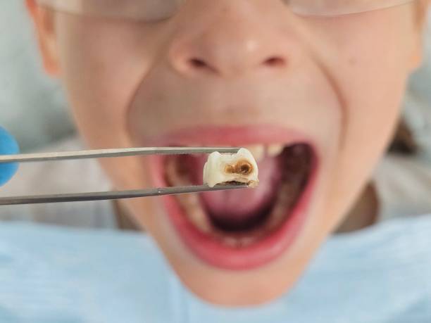 Best Emergency Dentist for Lost Fillings or Crowns in Wasco, CA